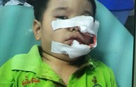 Bé 3 tuổi phải khâu 200 mũi trên mặt vì bị chó Phú Quốc cắn 