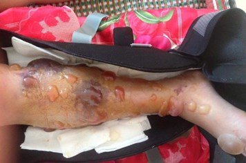 Đắk Lắk: Bác sĩ tắc trách, nữ sinh lớp 10 mất chân vĩnh viễn
